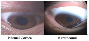 a keratoconus myopia